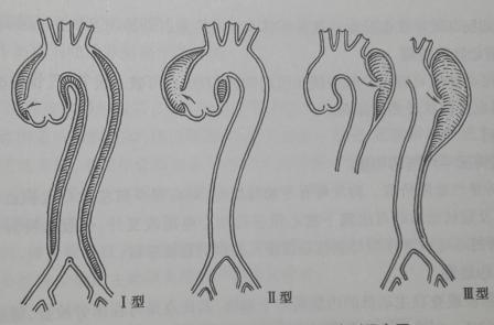 主动脉夹层，范贞医疗纠纷律师.jpg