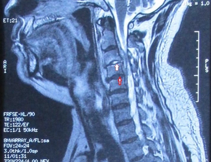 MRI颈椎间盘突出，范贞医疗纠纷律师