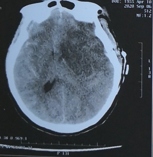 脑梗CT，医疗纠纷