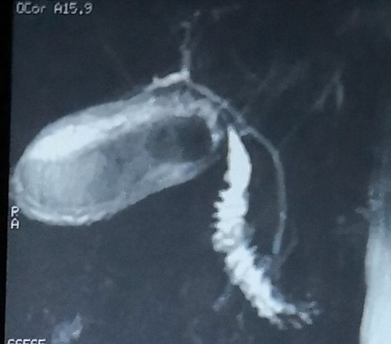 胆囊结石核磁，医疗纠纷