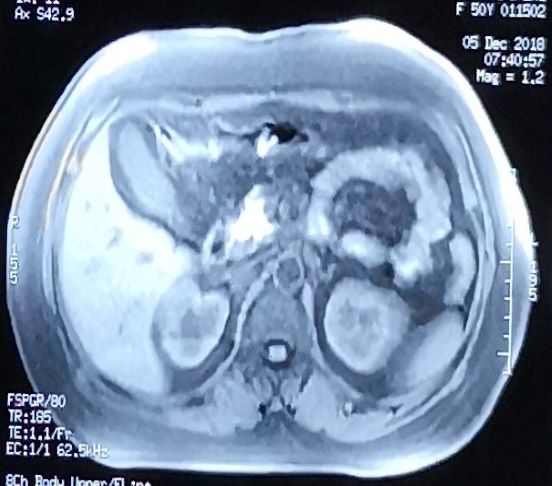 胆囊结石，胆囊炎核磁，医疗纠纷